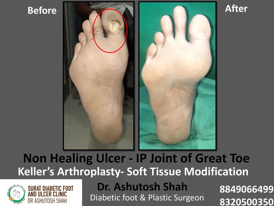 Diabetic Foot  PPT 3 checked by sir.pptx-70.webp